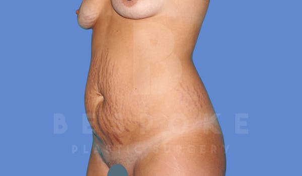Tummy Tuck Before & After Gallery - Patient 144270070 - Image 3
