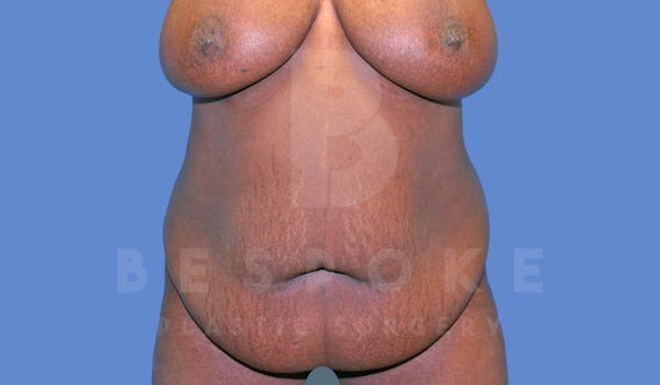 Tummy Tuck Before & After Gallery - Patient 144270069 - Image 1