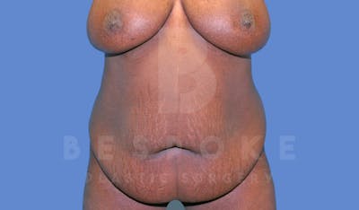 Tummy Tuck Before & After Gallery - Patient 144270069 - Image 1