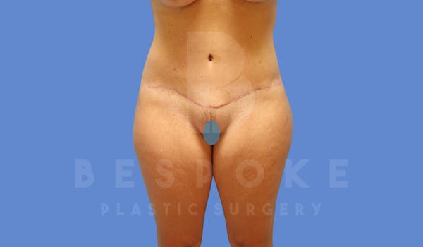 Tummy Tuck Before & After Gallery - Patient 144270068 - Image 2