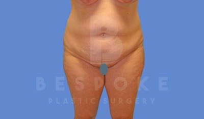 Tummy Tuck Before & After Gallery - Patient 144270068 - Image 1