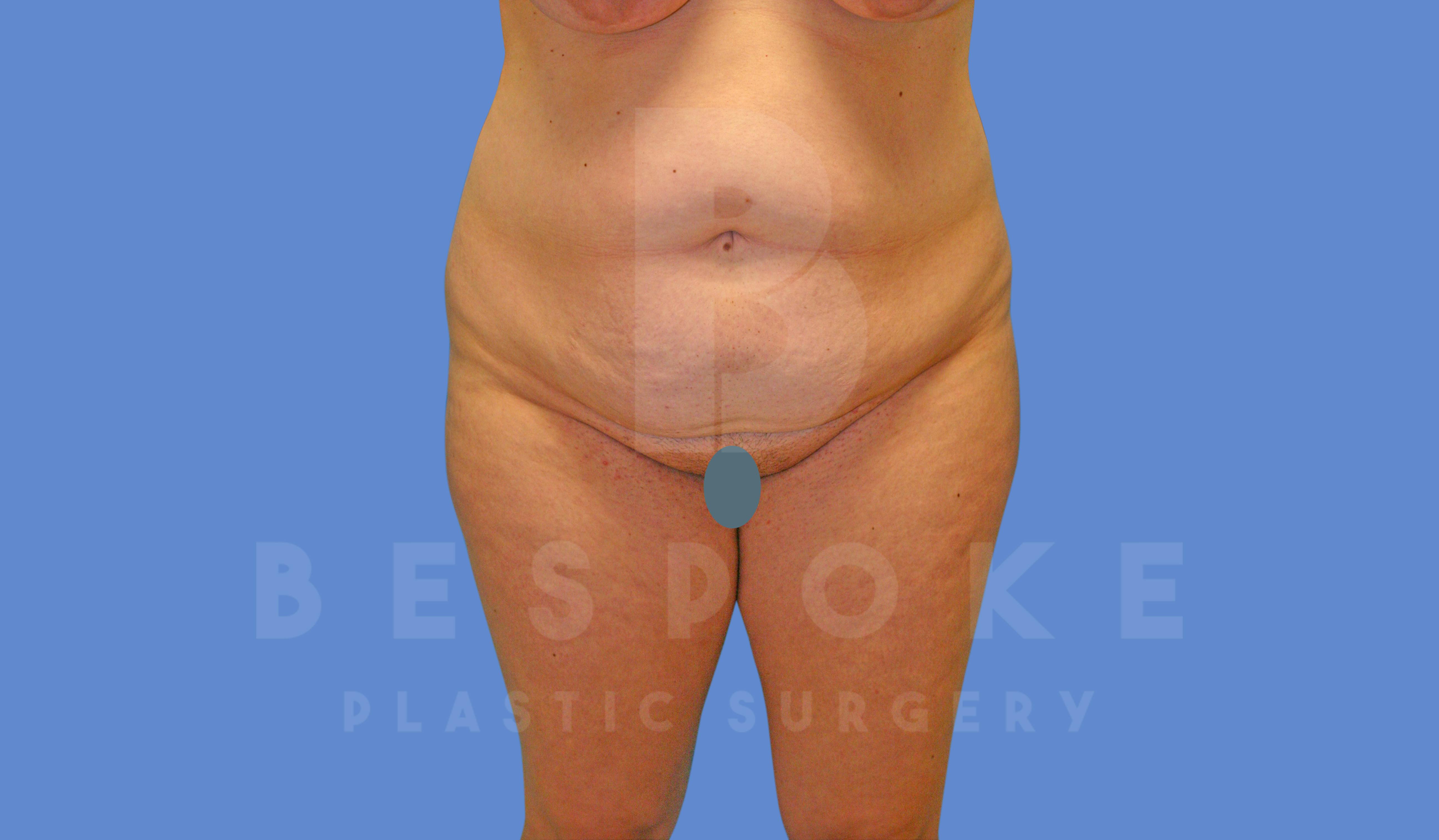 Tummy Tuck Before & After Gallery - Patient 144270068 - Image 1