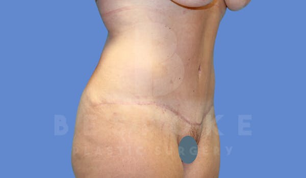 Tummy Tuck Before & After Gallery - Patient 144270068 - Image 4