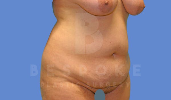 Tummy Tuck Before & After Gallery - Patient 144270068 - Image 3