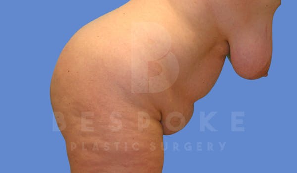 Tummy Tuck Before & After Gallery - Patient 144270068 - Image 5