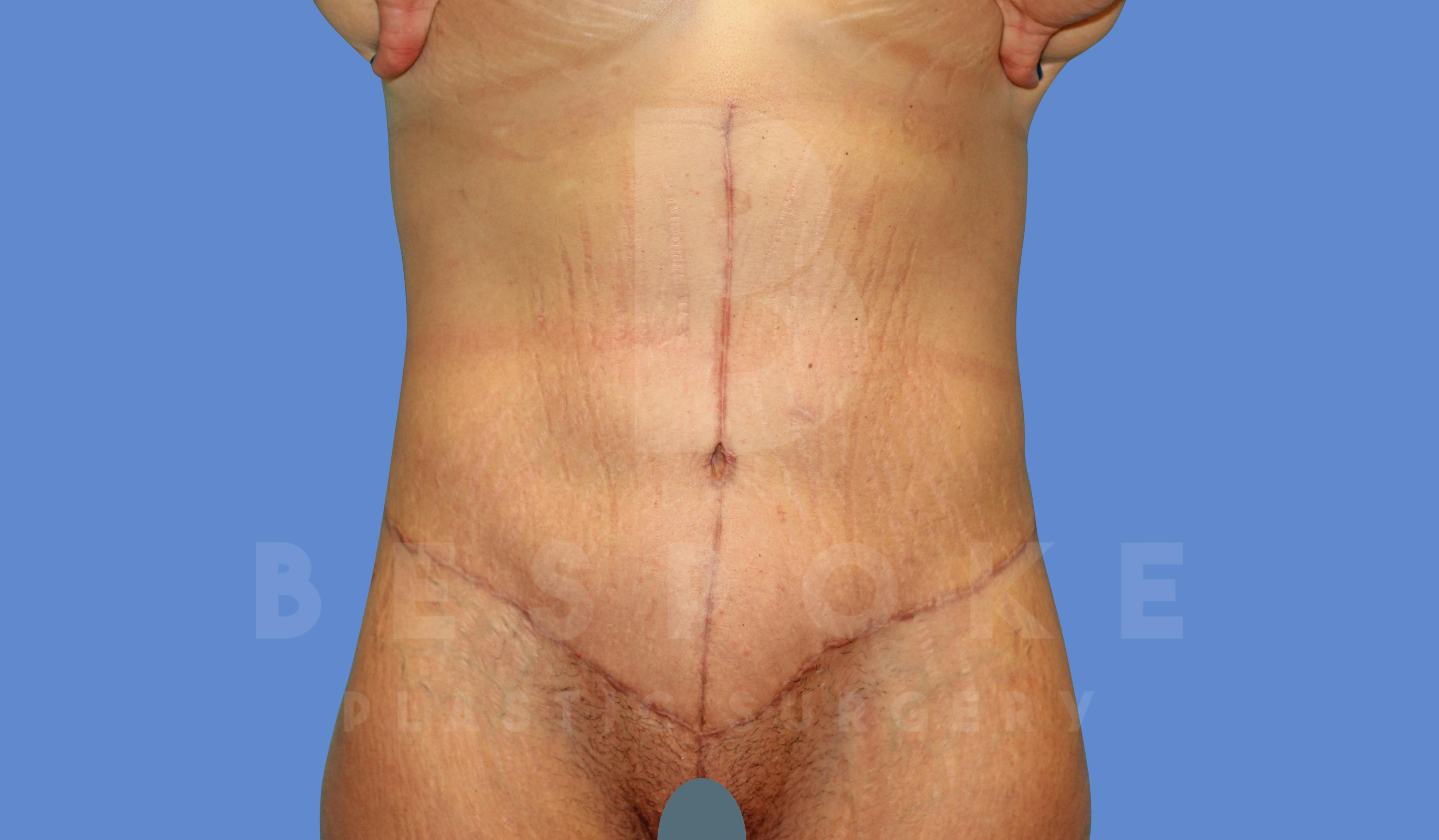 Massive Weight Loss Before & After Gallery - Patient 144270187 - Image 2
