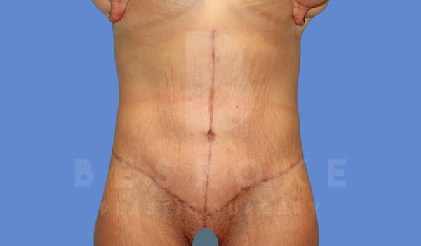 Massive Weight Loss Before & After Gallery - Patient 144270187 - Image 2