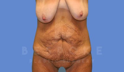 Massive Weight Loss Before & After Gallery - Patient 144270187 - Image 1