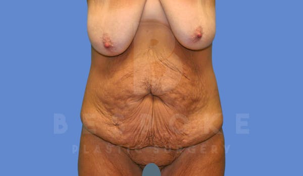 Massive Weight Loss Before & After Gallery - Patient 144270187 - Image 1