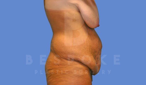 Massive Weight Loss Before & After Gallery - Patient 144270187 - Image 5