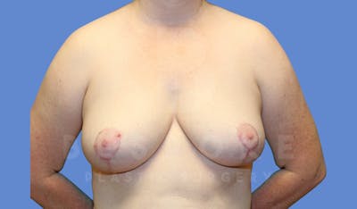 Breast Reduction Before & After Gallery - Patient 144270260 - Image 2