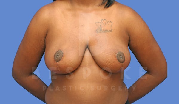 Breast Reduction Before & After Gallery - Patient 144270259 - Image 2