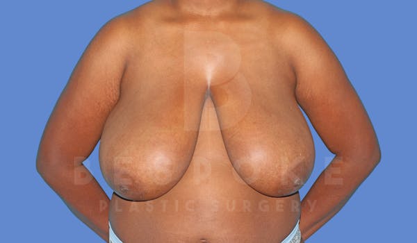 Breast Reduction Before & After Gallery - Patient 144270259 - Image 1