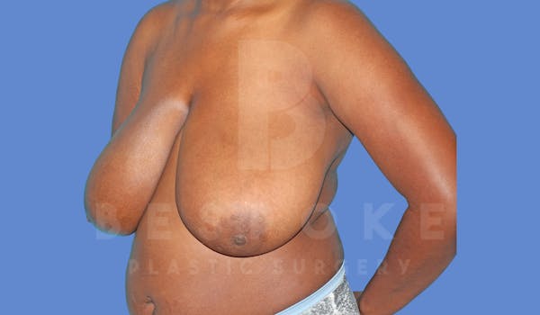 Breast Reduction Before & After Gallery - Patient 144270259 - Image 3