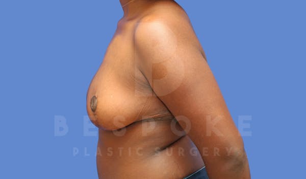 Breast Reduction Before & After Gallery - Patient 144270259 - Image 6