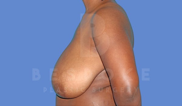 Breast Reduction Before & After Gallery - Patient 144270259 - Image 5