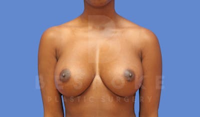 Breast Augmentation Before & After Gallery - Patient 144270491 - Image 2