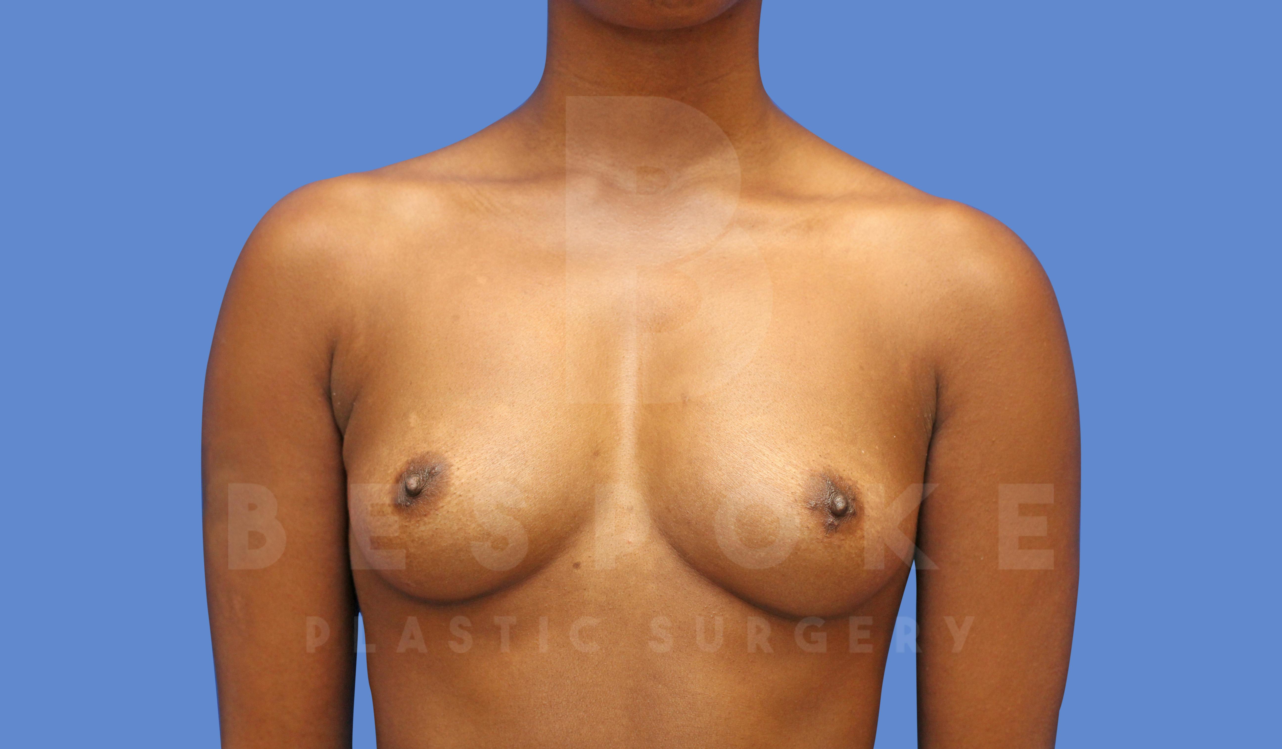 Breast Augmentation Before & After Gallery - Patient 144270491 - Image 1