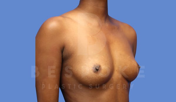 Breast Augmentation Before & After Gallery - Patient 144270491 - Image 3