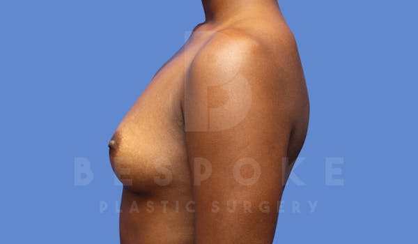 Breast Augmentation Before & After Gallery - Patient 144270491 - Image 5