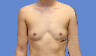 Breast Augmentation Before & After Gallery - Patient 144270490 - Image 1