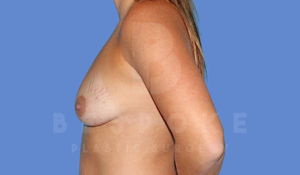 Breast Augmentation Before & After Gallery - Patient 144270489 - Image 5