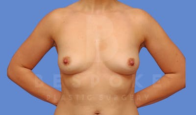 Breast Augmentation Before & After Gallery - Patient 144270488 - Image 1