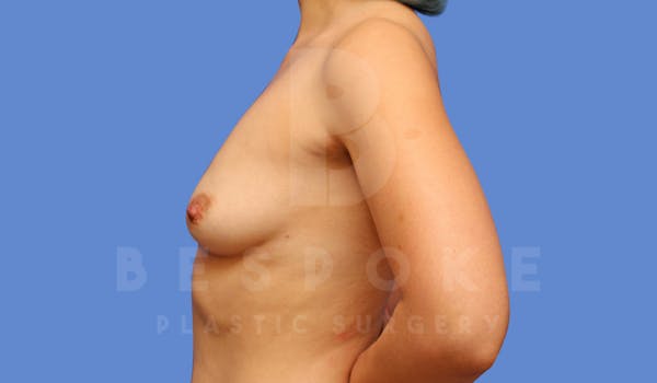 Breast Augmentation Before & After Gallery - Patient 144270488 - Image 5