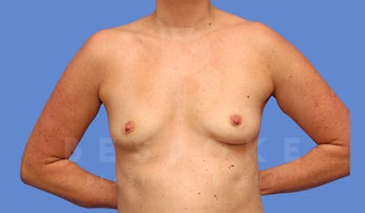 Breast Augmentation Before & After Gallery - Patient 144270487 - Image 1