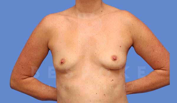 Breast Augmentation Before & After Gallery - Patient 144270487 - Image 1