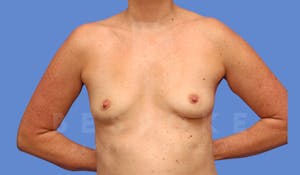 Charlotte NC Breast Augmentation Results