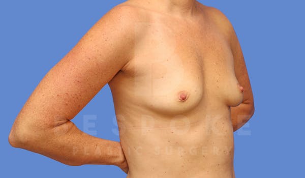 Breast Augmentation Before & After Gallery - Patient 144270487 - Image 3