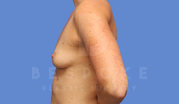Breast Augmentation Before & After Gallery - Patient 144270487 - Image 5