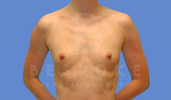 Breast Augmentation Before & After Gallery - Patient 144270486 - Image 1