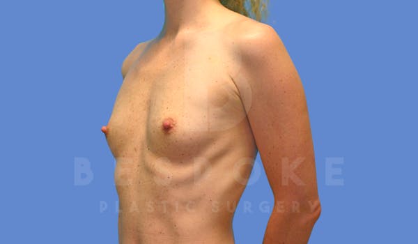 Breast Augmentation Before & After Gallery - Patient 144270486 - Image 3