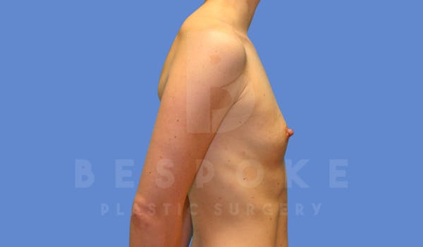 Breast Augmentation Before & After Gallery - Patient 144270486 - Image 5