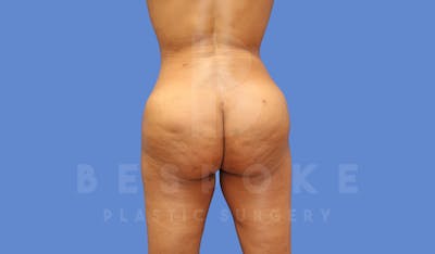 Brazilian Butt Lift Before & After Gallery - Patient 144270602 - Image 2