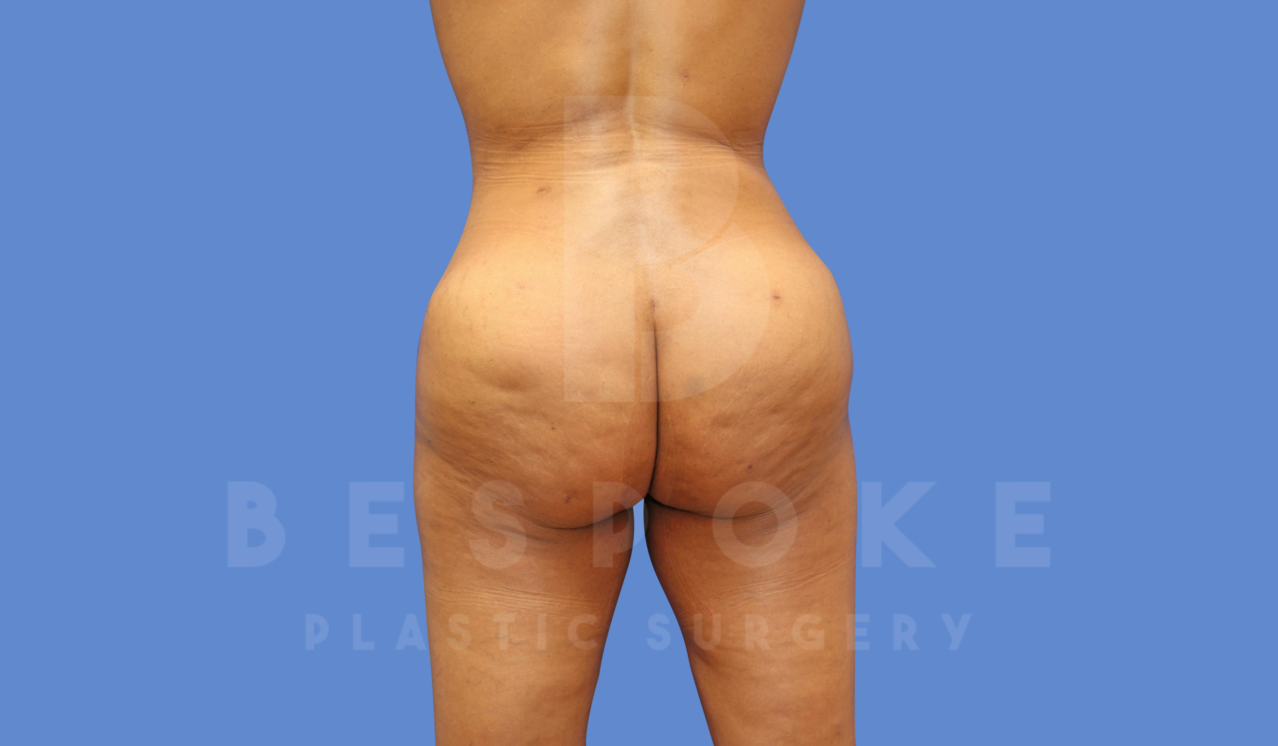 Brazilian Butt Lift Before & After Gallery - Patient 144270602 - Image 2