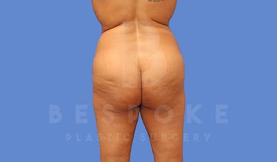 Brazilian Butt Lift Before & After Gallery - Patient 144270602 - Image 1