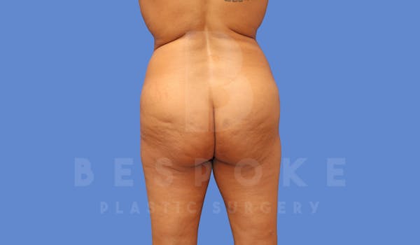 Brazilian Butt Lift Before & After Gallery - Patient 144270602 - Image 1