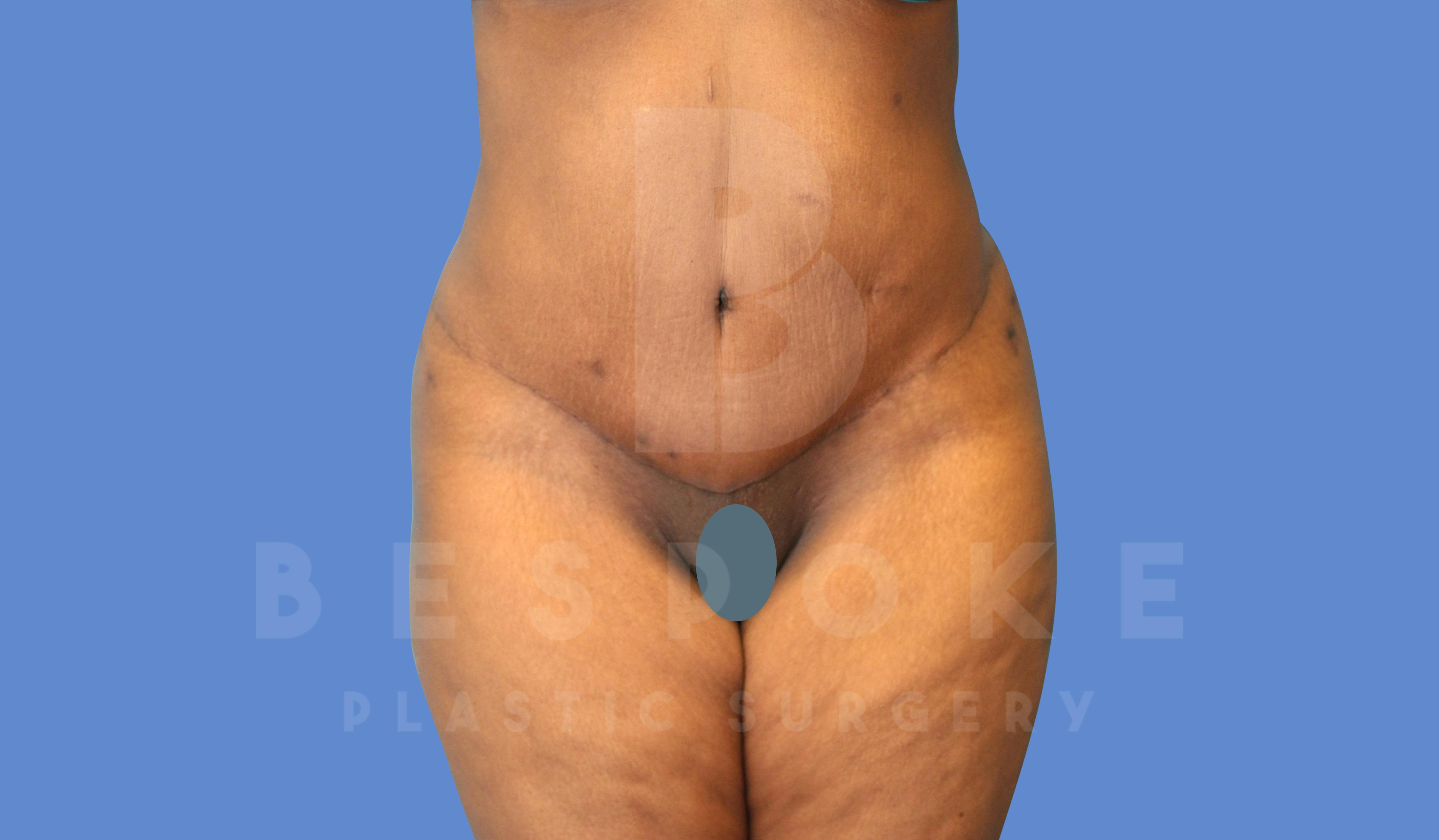 Tummy Tuck Before & After Gallery - Patient 144294015 - Image 2