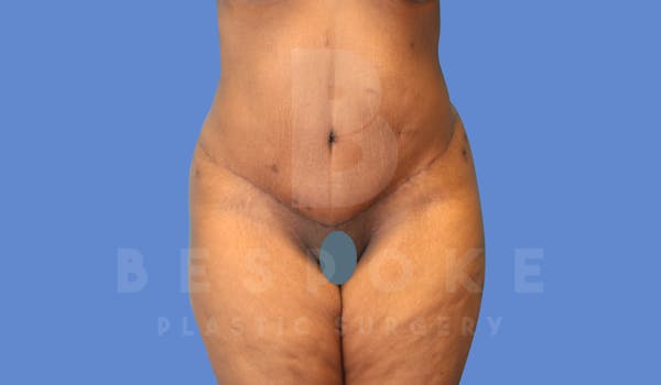Tummy Tuck Before & After Gallery - Patient 144294015 - Image 2