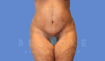 Tummy Tuck Before & After Gallery - Patient 144294015 - Image 2