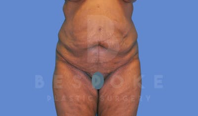 Tummy Tuck Before & After Gallery - Patient 144294015 - Image 1