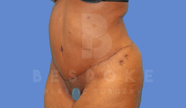 Tummy Tuck Before & After Gallery - Patient 144294015 - Image 4