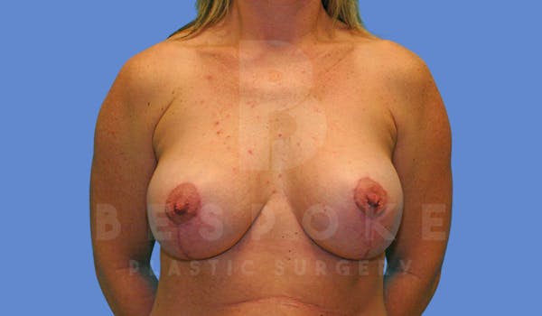 Breast Revision Surgery Before & After Gallery - Patient 144294103 - Image 2