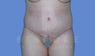 Massive Weight Loss Before & After Gallery - Patient 144294345 - Image 2