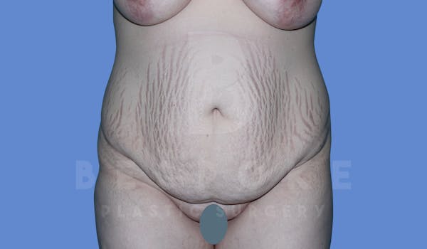 Massive Weight Loss Before & After Gallery - Patient 144294345 - Image 1