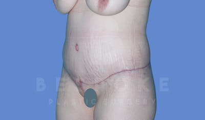 Massive Weight Loss Before & After Gallery - Patient 144294345 - Image 4