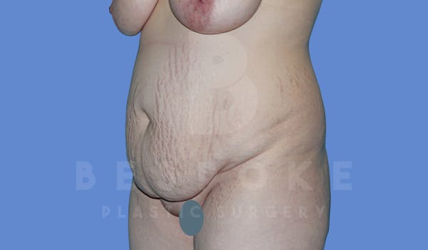 Massive Weight Loss Before & After Gallery - Patient 144294345 - Image 3